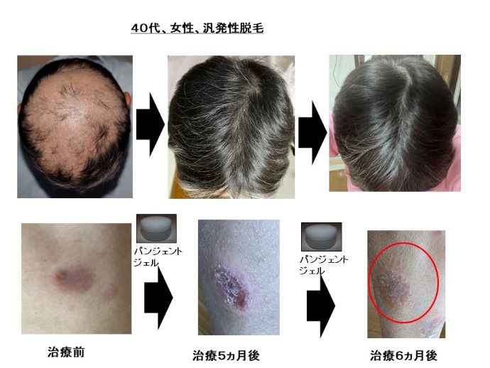 円形脱毛症　病院